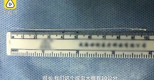 Doctors remove live 10cm tapeworm from Chinese man's brain | New Straits Times