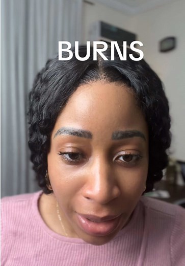 Using Pure Honey for Effective Burn Relief