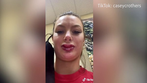 Woman's lips become swollen and bruised after lip injections