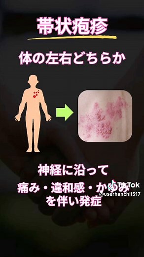 帯状疱疹の初期症状と対策