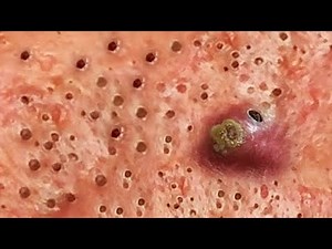 Ear Blackhead professional extraction - Full Video of blackhead removal on ear