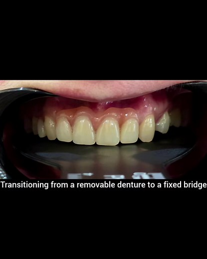 Fixed Bridge vs. Dentures: Secure Smile Solution
