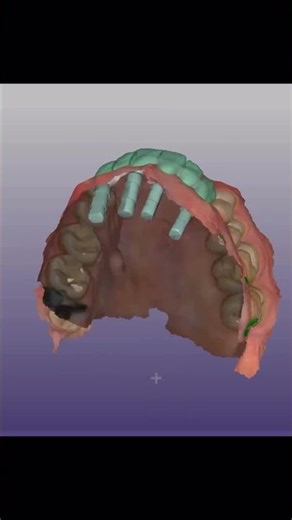 EXOCAD3.3 IMPLANT BAR BRIDGE download end install
