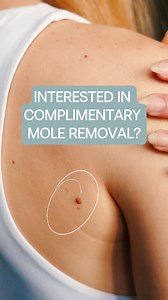 Thinking about mole removal? We’re offering 10 complimentary mole removal treatments at Contour Clinics for a limited time by our most experienced cosmetic physician. We ensure your safety and satisfaction by closely monitoring your healing with daily photos and regular in-clinic reviews. Interested? Simply fill out the form, and we'll be in touch! | Contour Clinics