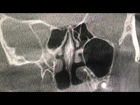 Deviated Nasal Septum explained with Cone Beam CT scan