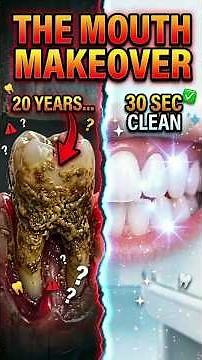 20 Years of Plaque Removed in 30 Seconds 😱 (3D Deep Clean)