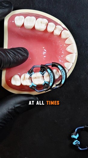 Stacking Without a Tall Ring in Quad Matrix System