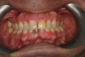 Non-vital bleaching of a dark tooth in the aesthetic zone - Dentistry.co.uk