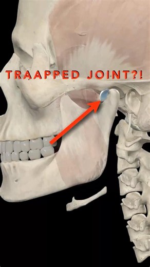 Why your jaw gets stuck on one side. #tmjwhispereracademy #dentallearning #jawclick
