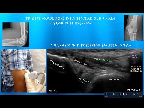 Ultrasound of a Triceps Tendon Avulsion-2 years after the Injury, by probeultrasound.com