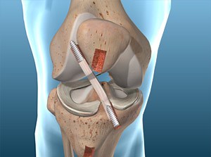 ACL Reconstruction (Patellar Tendon Graft Technique) in Washington DC, Virginia, and Maryland