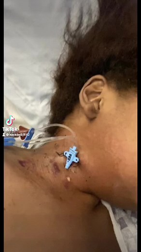 Going into a coma & being intubated 5 times in one hospital stay all within 3 weeks is crazyyyyyyy😩 #fyp #viral #lupuswarrior #kidneyfailure #heartfailure