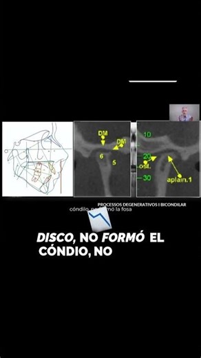 “The Hidden Bilateral Condylar Degeneration Problem No One Is Talking About 🧠🦷” #ortodoncia