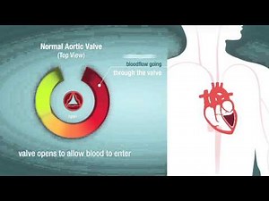 Valve Stenosis: When a Heart Valve is Too Narrow