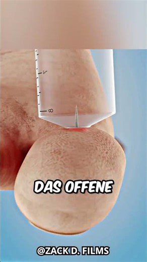 Wie man einen Splitter schmerzfrei entfernt