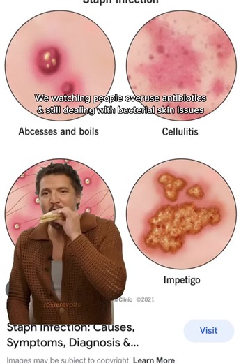 Understanding Bacterial Skin Infections: Symptoms & Treatments