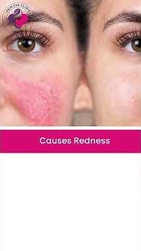 Common Skin Problem: Rosacea Explained | What Causes Sudden Facial Redness? | Dr. Sunil Kothiwala