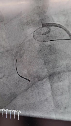 Z , 2 mo old 3 kg DX as pulmonary atresia VSD PDA dependant circulation. Aortogram showed vertical PDA with some stenosis of RPA LPA origin. We stationed wire both in LPA and RPA and 4x18 mm premier plus DES stent forwarded through RPA wire and deployed . Post aortogram showed good flow in both lungs . It was a life saving intervention. | Fatema, s Congenital heart desk.