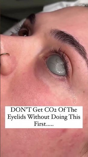 Metal Eye Shields The Ultimate Eye Protection in Aesthetic Treatments #SkinSafety #EyeProtection