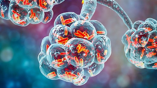 Infectious Diseases A-Z: What you need to know about pneumonia - Mayo Clinic News Network