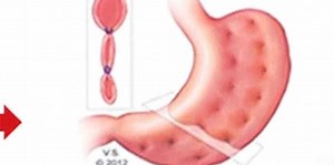 There's A Simple New Weight Loss Procedure That's Changing The Game