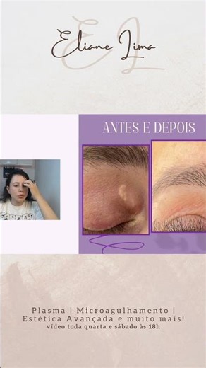 Lobuloplasty: Before and After with Plasma Pen! ⚡✨