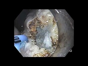 Colonoscopy: EMR of a Rectal Cancer in an Adenoma • Video • MEDtube.net