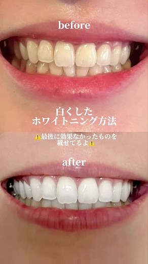 オパールエッセンスで白い歯を手に入れよう