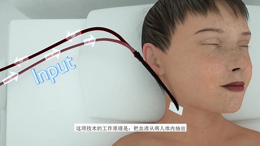 ECMO技术动画 人工心肺机 为新冠肺炎病危患者挽回生命带来希望