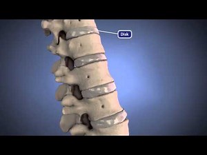 Herniated Disk