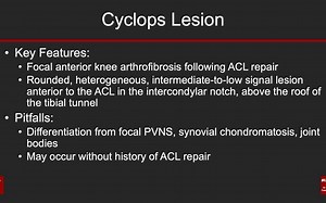 MSK Case of the Day 27（Cyclops病变，前交叉韧带重建术后）