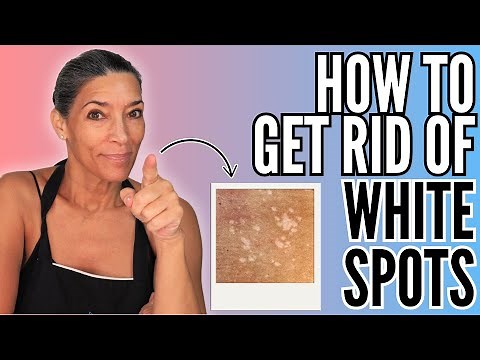 Say GOODBYE to White Spots on Your Skin NATURALLY! | Peaches Skin Care