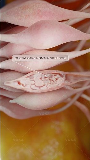 Is ductal carcinoma in situ a risk for developing invasive breast cancer? 3D visualization