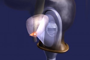 Healthy Living: HIFU Zaps Prostate Cancer