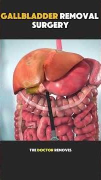 How Gall Bladder Removal Surgery Is Performed | Cholecystectomy Explained #GallBladderRemoval