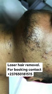 1.3K views · 21 reactions | Laser hair removal is a cosmetic...