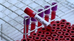 AST test to look for abnormalities from blood, blood sample to analyze in the laboratory, blood in test tube
