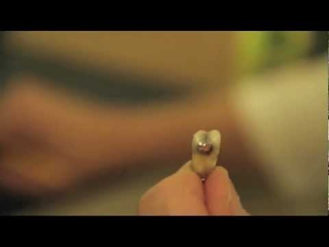 The Smoking Tooth Part 1 of 3 | Mercury Filling Removal