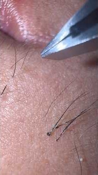 #髭脱毛 #スッキリ#毛根 #髭抜き #毛抜き pluck beard barba depilare take out マクロカメラmicro микро #pimple 除去 #埋没毛 高画質推奨