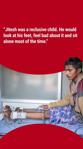 Clubfoot causes excruciating pain and disability if left untreated. But it's easier to fix when caught before walking age. | CBM Australia