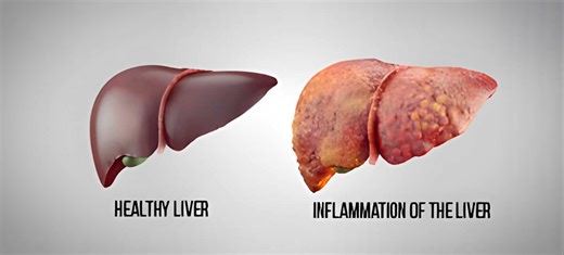 Fatty Liver Disease Explained: Why Cases Are Rising Worldwide and Who's Most at Risk