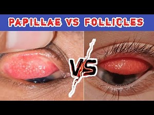Papillae vs follicles | explained indetail @eyecareoptom #papillae #follicle #pink eye