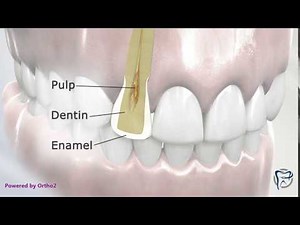 Interproximal Reduction