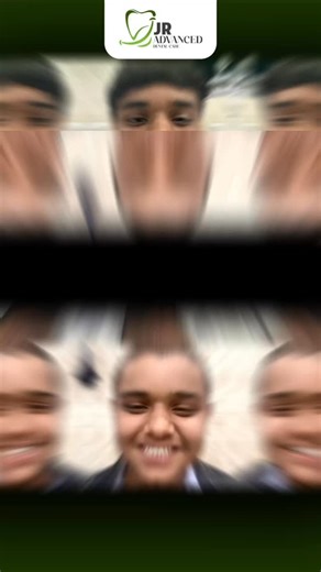 Dr Purushotam verma on Instagram: "✨ SMILE TRANSFORMATION WITH COMPOSITE RESTORATION ✨ A beautiful smile doesn’t always need major procedures — sometimes, precision makes all the difference 💫 Check out this Before & After Composite Restoration, designed to restore shape, alignment, and confidence naturally 🦷💎 At JR Advanced Dental Care, we focus on aesthetics, comfort, and long-lasting results using advanced dental techniques. 📌 Services Available: ✔ Veneers ✔ Braces ✔ Aligners ✔ Dental Impl