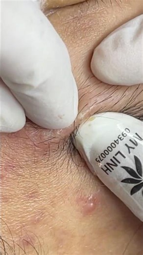 acne on eyebrows 😂 #skincare #pimple #blackhead #blackheads #satisfying