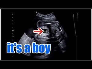 Ultrasound Showing baby boy | Male fetus at 26 weeks | Male fetus