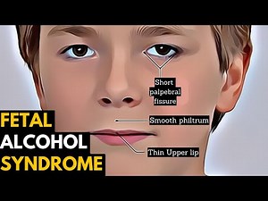 How to Recognize Fetal Alcohol Syndrome