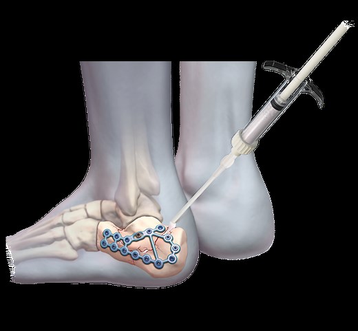 BoneSync™ Synthetic Bone Void Fillers