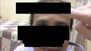 8.2K views · 249 reactions | [Medical student] Glabella tap reflex...