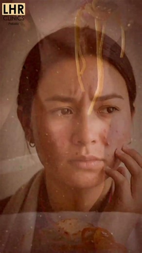 5 Common Mistakes That Cause Acne | Stop These Habits for Clear Skin #acnetreatment #clinicpatiala